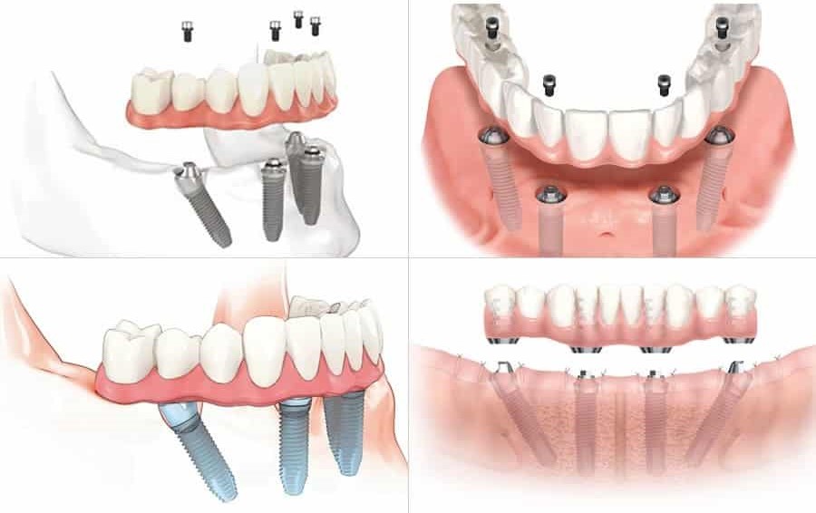 all-on-4-implants