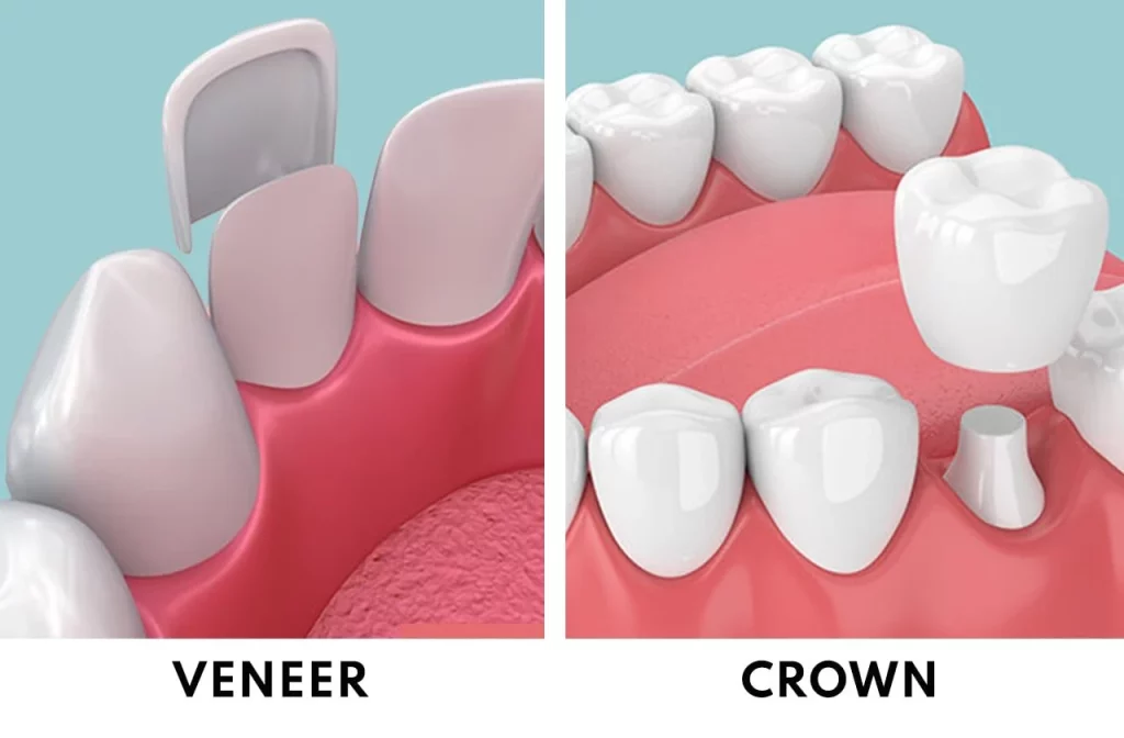 veneers vs crowns